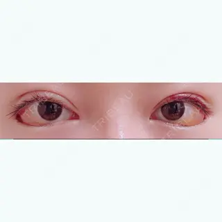 9日目の経過画像（1枚目）