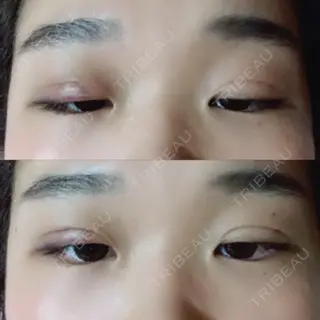 2日目の経過画像（1枚目）