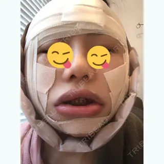 0日目の経過画像（1枚目）