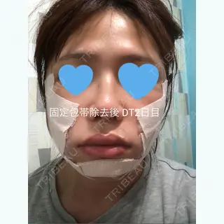 0日目の経過画像（1枚目）