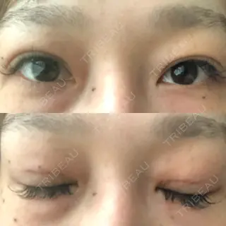 1日目の経過画像（2枚目）