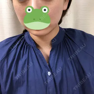 0日目の経過画像（3枚目）