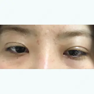 20日目の経過画像（3枚目）