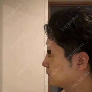 4日目の経過画像（1枚目）