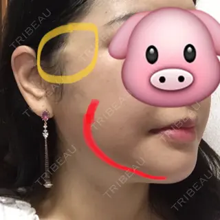 14日目の経過画像（2枚目）
