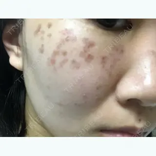 3日目の経過画像（2枚目）
