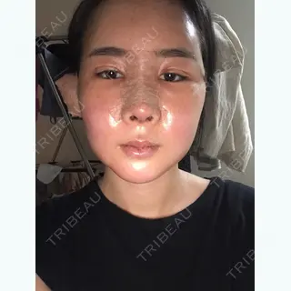 2日目の経過画像（1枚目）