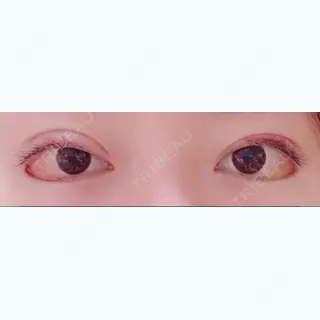 12日目の経過画像（1枚目）