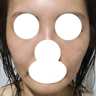 4日目の経過画像（1枚目）