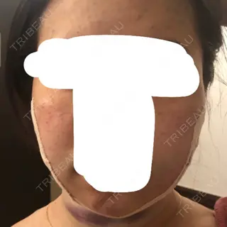0日目の経過画像（1枚目）