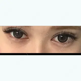 20日目の経過画像（1枚目）