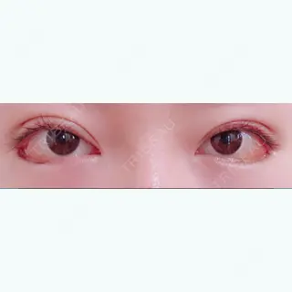 14日目の経過画像（1枚目）