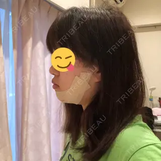 4日目の経過画像（2枚目）