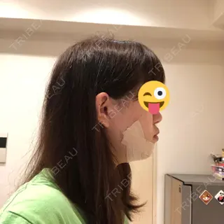 4日目の経過画像（3枚目）