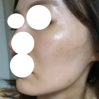 6日目の経過画像（2枚目）