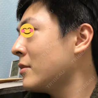 180日目の経過画像（3枚目）