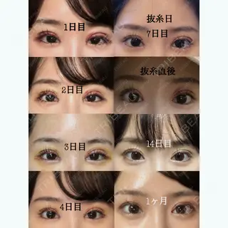 32日目の経過画像（1枚目）