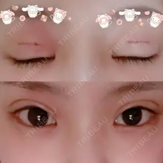 3日目の経過画像（1枚目）