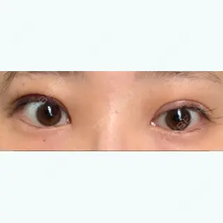 2日目の経過画像（1枚目）