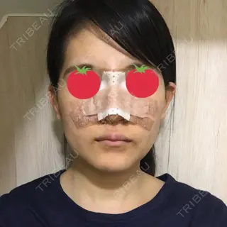 5日目の経過画像（1枚目）