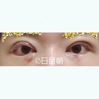 13日目の経過画像（1枚目）