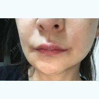 69日目の経過画像（1枚目）