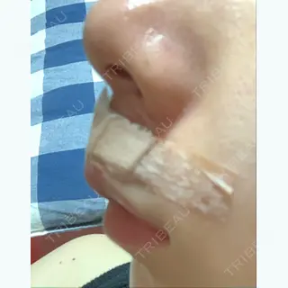 1日目の経過画像（2枚目）