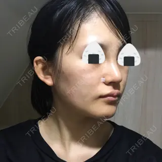 6日目の経過画像（2枚目）