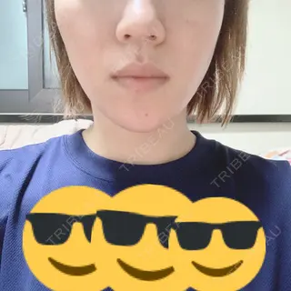 0日目の経過画像（1枚目）