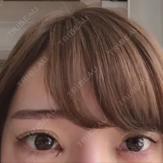 0日目の経過画像（1枚目）