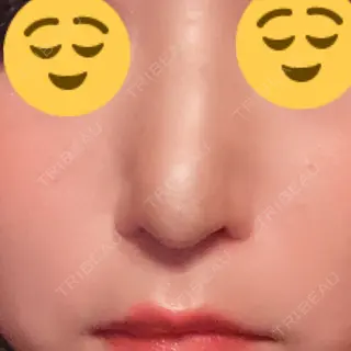13日目の経過画像（1枚目）