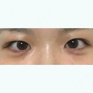 1日目の経過画像（1枚目）