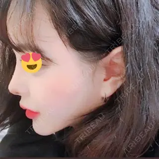 33日目の経過画像（1枚目）