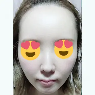 33日目の経過画像（1枚目）