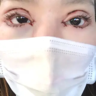 0日目の経過画像（1枚目）