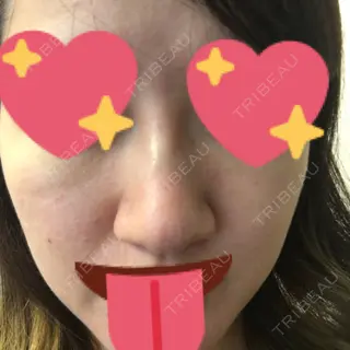 0日目の経過画像（1枚目）