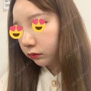 5日目の経過画像（2枚目）