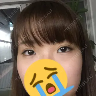 3日目の経過画像（2枚目）