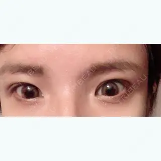 47日目の経過画像（2枚目）