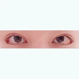 20日目の経過画像（1枚目）