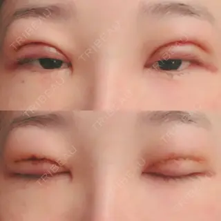 2日目の経過画像（1枚目）