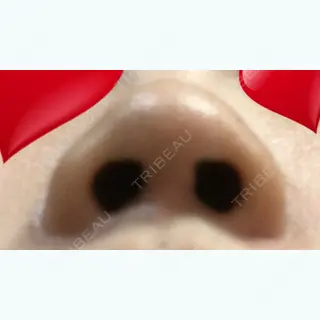 31日目の経過画像（2枚目）