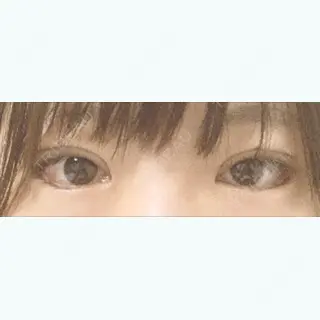15日目の経過画像（1枚目）