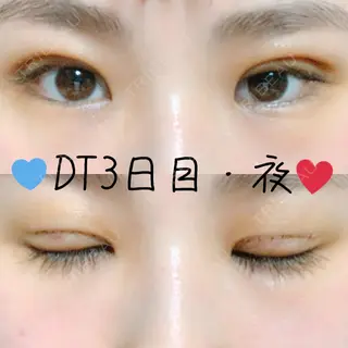 3日目の経過画像（1枚目）