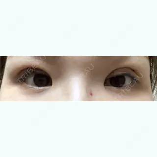 5日目の経過画像（1枚目）