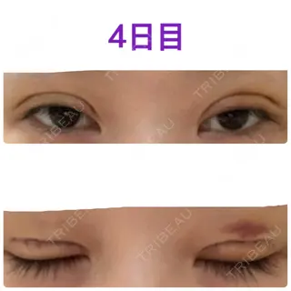 4日目の経過画像（1枚目）