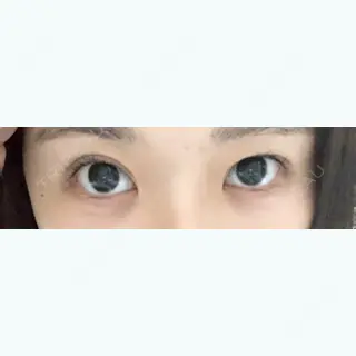 34日目の経過画像（1枚目）