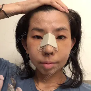 4日目の経過画像（1枚目）