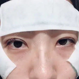0日目の経過画像（3枚目）