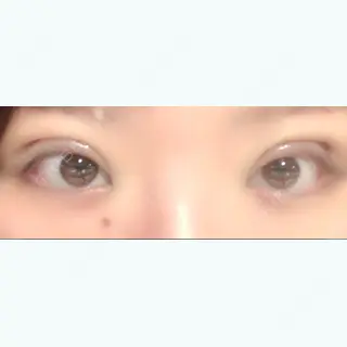 0日目の経過画像（1枚目）